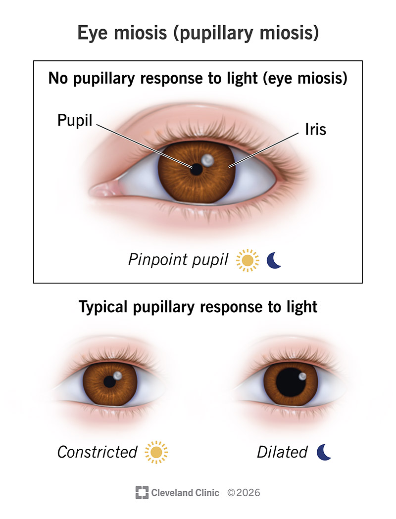 ClevelandClinic's tweet photo. Eye miosis means something is making the pupils in one or both of your eyes smaller than usual. They may be very small, like pinpoints. Everything from eye conditions and medication side effects to injuries can cause miosis. A healthcare provider will recommend treatments for the condition or injury that’s causing the miosis. Your provider will give you an eye exam. You may need tests, like a CT scan or MRI, or blood or urine tests. Visit a healthcare provider or eye doctor as soon as you notice any changes in your eyes or vision. Especially if your eyes hurt. The sooner a provider diagnoses what’s causing the miosis, the better.