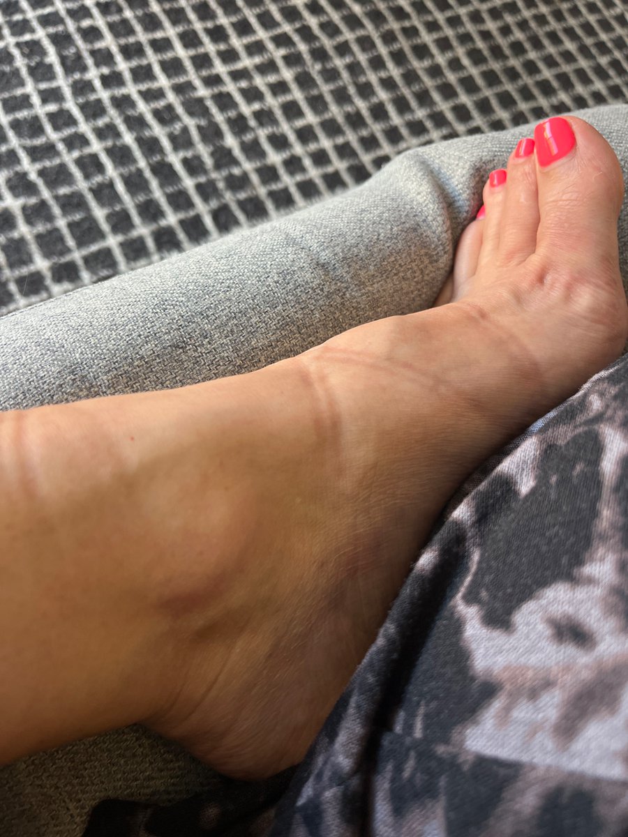 bipedluv's tweet photo. My sandals are comfortable, but boy do they leave a mark https://t.co/j99LQUqxvY