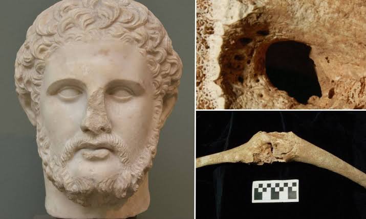 histories_arch's tweet photo. Philip II of Macedon, father of Alexander the Great, was one of antiquity’s most formidable rulers, known for transforming Macedonia from a minor kingdom into a dominant military power. His life was marked by constant warfare, diplomacy, and political intrigue, and he accumulated a long list of severe injuries throughout his campaigns: a blinded eye, a shattered leg, and multiple wounds that permanently altered his body. These injuries were so well documented by ancient historians that they became a unique forensic signature centuries later.

When an elaborate tomb was uncovered in 1977 at Vergina, archaeologists suspected it belonged to Philip II, but the evidence remained debated for decades. Only recently did forensic anthropologists confirm the identification by matching the skeleton’s dramatic injuries, especially the damaged eye socket and fused leg bones, with the historical record. This made Philip II the only known figure from antiquity whose remains were definitively identified through a written physical description rather than inscriptions or artifacts.

The discovery reshaped our understanding of Macedonian burial practices and offered a rare, intimate connection to a pivotal historical figure. It also highlighted how modern science can bridge millennia, allowing historians to verify identities once thought lost to time. Philip II’s confirmed remains provide a tangible link to the man who laid the foundation for Alexander the Great’s empire, turning a legendary biography into a physical reality.

#archaeohistories