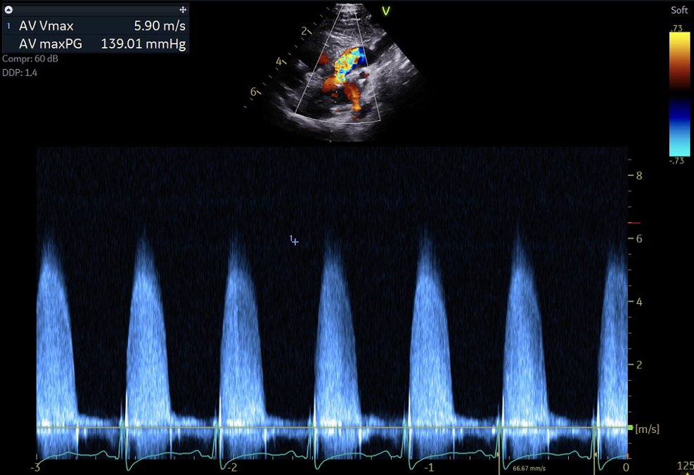 CardioNeo's tweet photo. New NeoCardioLab Case of the Month: Critical Aortic Valve Stenosis. Explore how fetal-to-postnatal transition changes Doppler gradients, with imaging, physiology, stabilization, intervention, and an NH-TNE video case review.

https://t.co/x9Yv3qKSLb https://t.co/PN9TMjeY6E