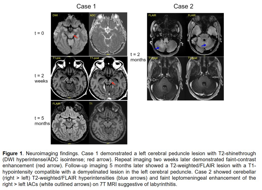 MSJ_Research's tweet photo. Enterovirus infection in B-cell depleted patients may cause severe central nervous system involvement, and early IVIg and investigational antivirals may be considered.

Narrative review with two illustrative cases from @AKunchok @ClevelandClinic ▶️ https://t.co/J6b3HoA2Nu https://t.co/PWwzRevNsy
