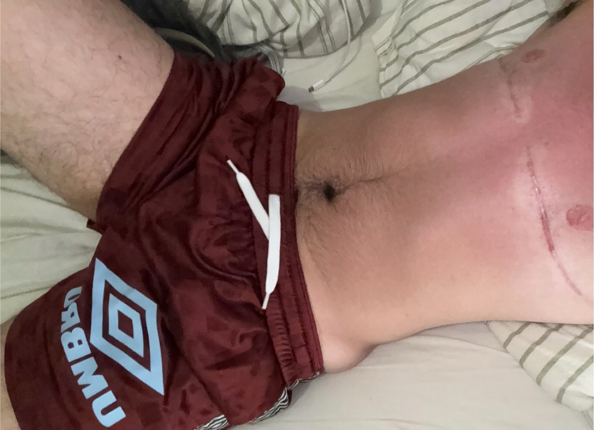 PR3TTIPUPPI's tweet photo. new gay little shorts 😛. (feat my fuckass sunburn LMAO) https://t.co/7M8317Ykfw