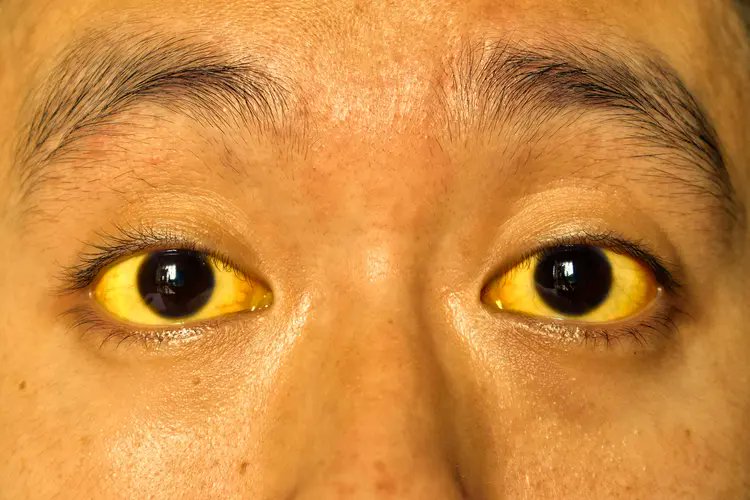 icalbhimaa's tweet photo. Kata temen yang dokter, kita tuh jangan sampe beli di pedagang yang fisiknya kayak gini. Emang bener ya?

Ada yang tahu alasannya nggak boleh beli di pedagang yang matanya kuning gini? https://t.co/zB6wUSGv3F