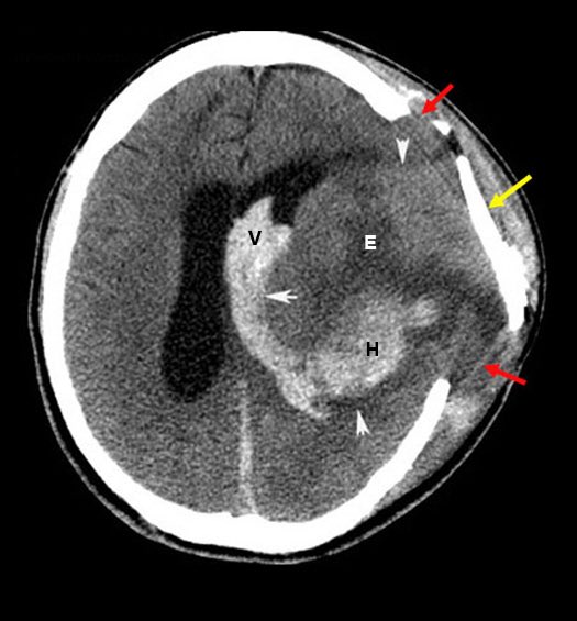 IFC_dunkle's tweet photo. Breaking News: IFC Fighter Steven Hankey has suffered several skull fractures and a severe brain hemorrhage ahead of his bout with Mauricio Barbosa at #IFC29. The fight will proceed anyways, with Hankey explaining “Huuuuuuu…ehaaaahaha…” Wise words, indeed. https://t.co/kj1FXbiulI