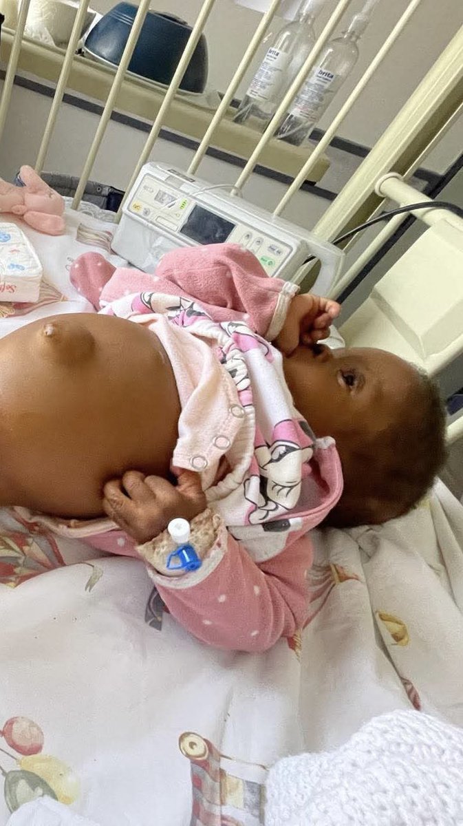 CrimeWatchZW's tweet photo. PLEASE SHARE🙏🏾 | One-year-old Naomi Chigwada is ill and urgently needs a liver transplant, and her family is appealing for help to raise US$18,000 for her life-saving treatment.

Naomi cannot receive the transplant in Zimbabwe because the procedure is not available locally. Her only chance is to travel to India, where one of her parents can be the living donor, allowing the transplant to be done without a long waiting list.

The money raised will cover the cost of the transplant, as well as travel and accommodation for Naomi and her parents during treatment.

Naomi’s family is asking for your support. If you are unable to donate, please consider sharing this post. A single share could help the fundraiser reach someone who is able to assist.

Every donation, share, and message of support brings Naomi one step closer to the treatment she urgently needs.

You can contribute via Ecocash or Innbucks using 0772528286 (Confidence Kundhlande). A GoFundMe link is also available below.