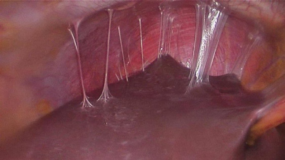 TrackYourHeart's tweet photo. Appearance of the liver during laparoscopy in a patient with chronic abdominal pain. What’s the diagnosis? https://t.co/ebegPcr51N