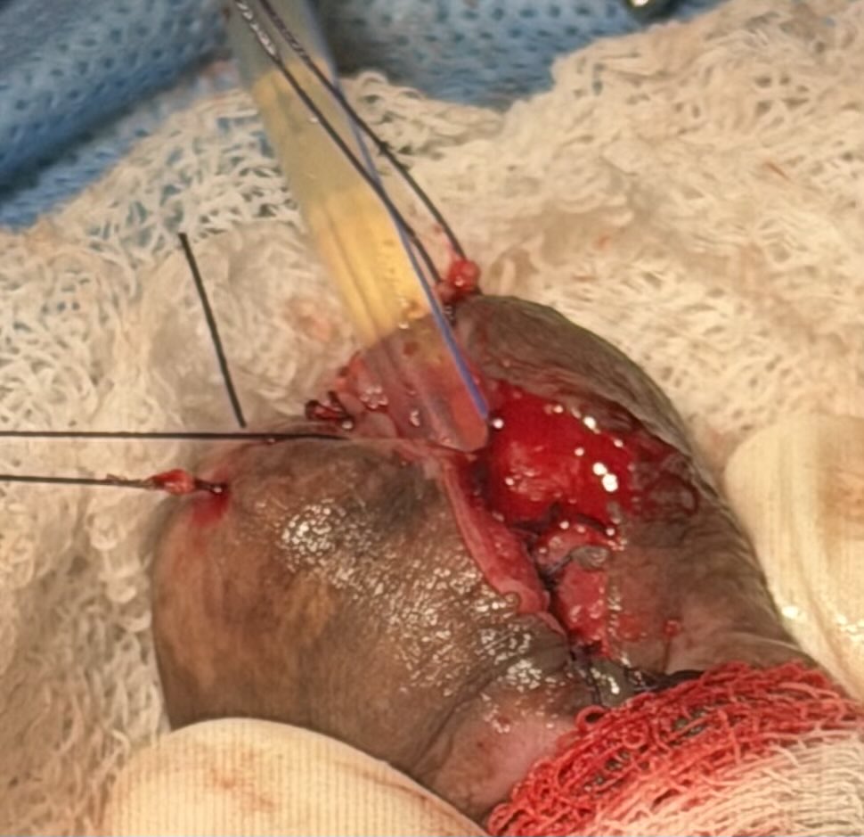PrajwalPaudyal's tweet photo. Dorsal inlay ( Asopa technique ) BMG urethroplasty for fossa navicularis stricture https://t.co/GfMB8PbHkE