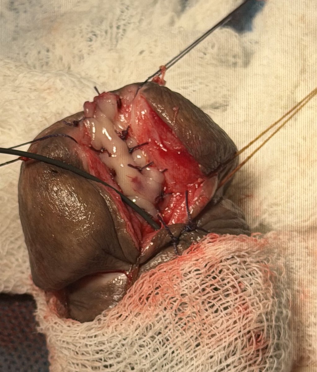 PrajwalPaudyal's tweet photo. Dorsal inlay ( Asopa technique ) BMG urethroplasty for fossa navicularis stricture https://t.co/GfMB8PbHkE