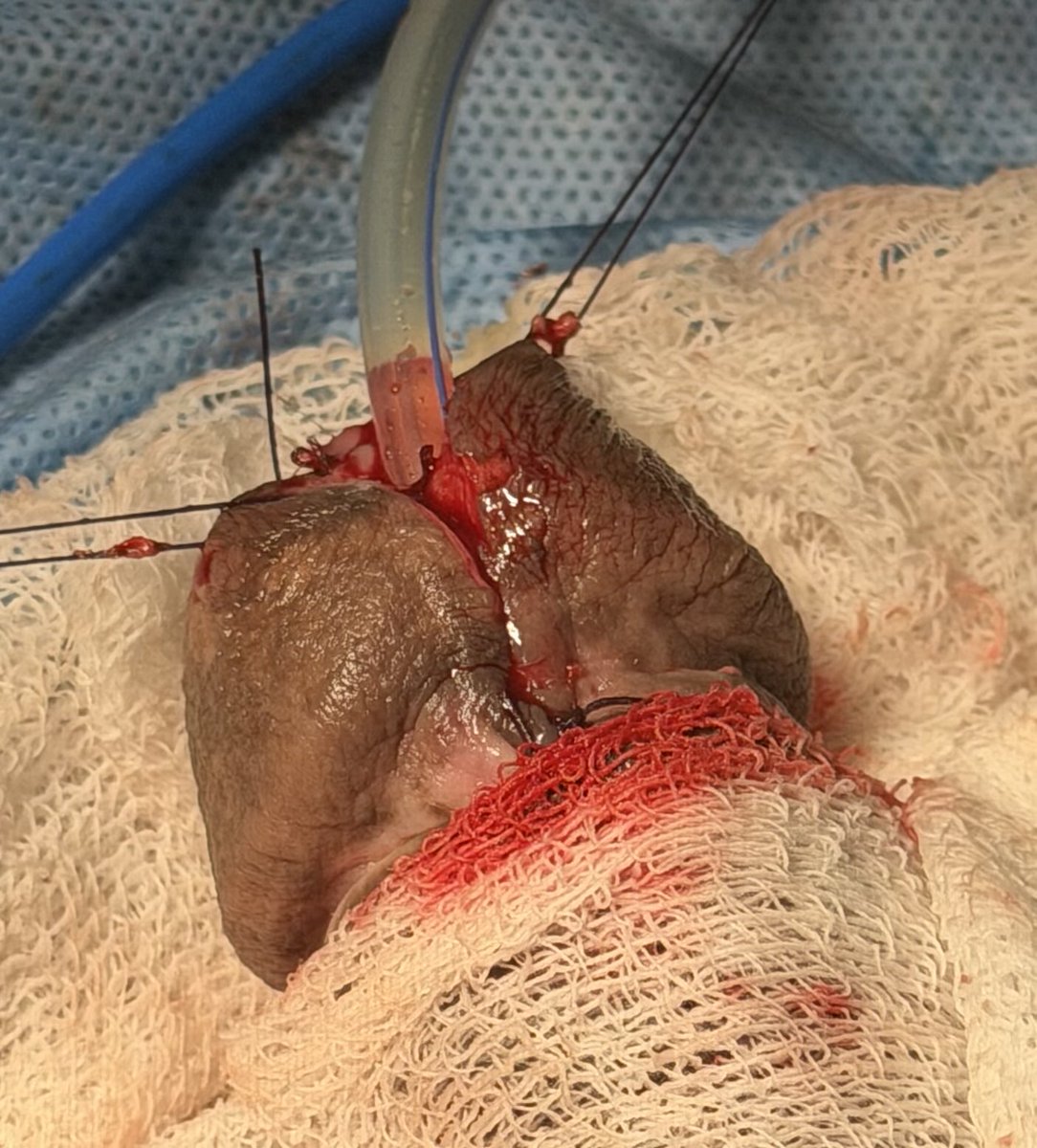 PrajwalPaudyal's tweet photo. Dorsal inlay ( Asopa technique ) BMG urethroplasty for fossa navicularis stricture https://t.co/GfMB8PbHkE