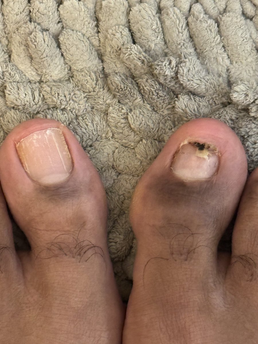 imgoonintoit's tweet photo. @UlisesDavid__ I can tell u rn my toe nail never grew back after a 4 inch pvc pipe fell on it and my toe nail went deep into my skin when it happened so now I still have the damage their from the accident and half a toe nail now https://t.co/StilTiu9a9