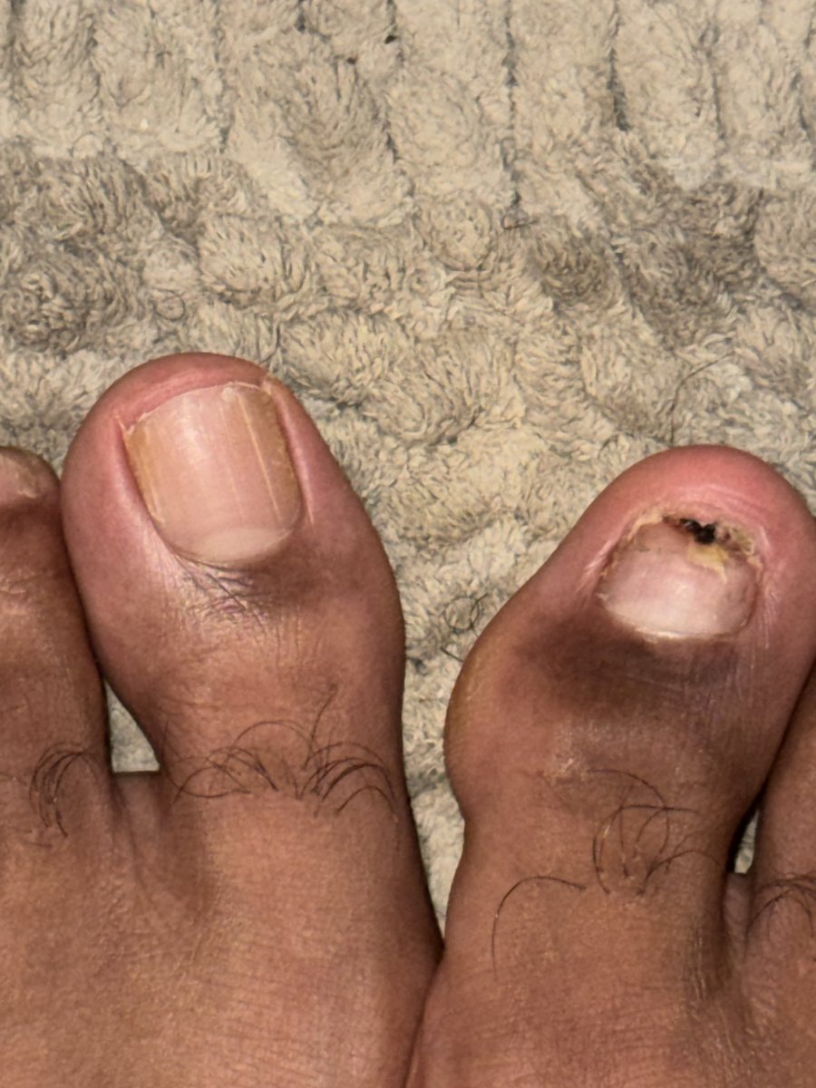 imgoonintoit's tweet photo. @UlisesDavid__ I can tell u rn my toe nail never grew back after a 4 inch pvc pipe fell on it and my toe nail went deep into my skin when it happened so now I still have the damage their from the accident and half a toe nail now https://t.co/StilTiu9a9