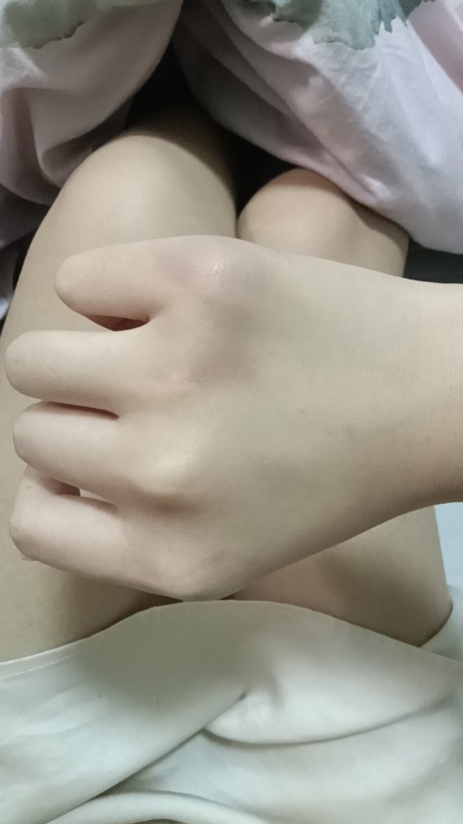 Qmikeylwr's tweet photo. 我的手为什么青了一块… https://t.co/sbImXuiC84