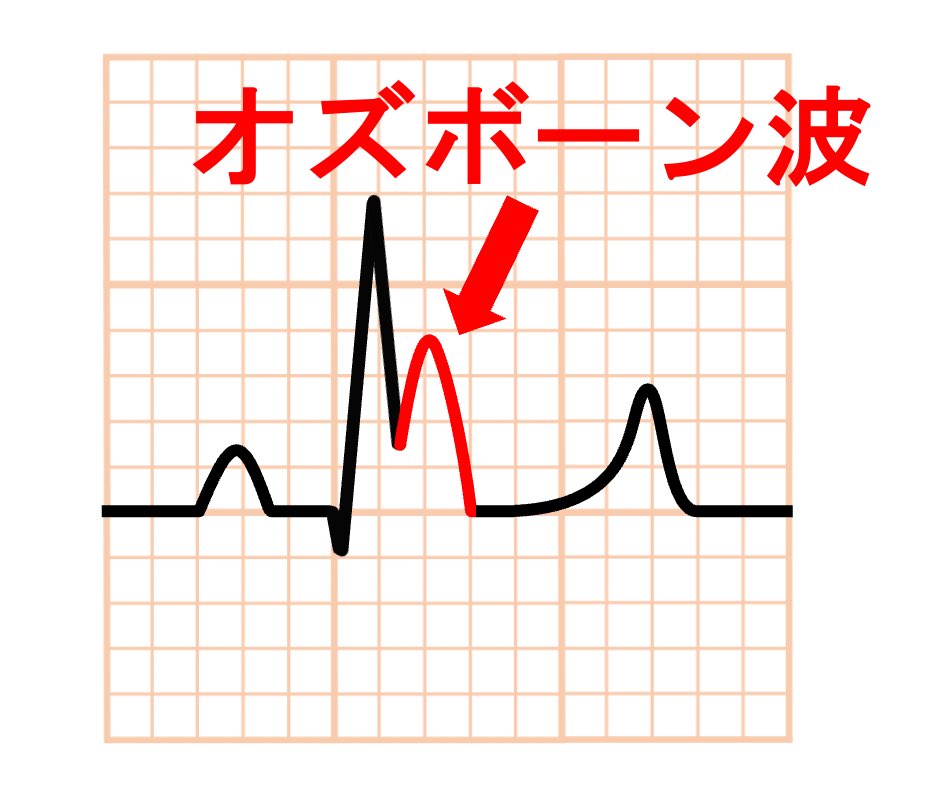 sindenzu1's tweet photo. 低体温症は特徴的な心電図変化を引き起こし、J点でのノッチを認めオズボーン波(J波)として知られています。尖ったノッチというよりは丸みを帯びたドーム様の波形が典型的とされます。「ドーム状(dome-shaped)」または「こぶ状(hump-like)」と表現されることが多いです。 https://t.co/2pd6HjSyke