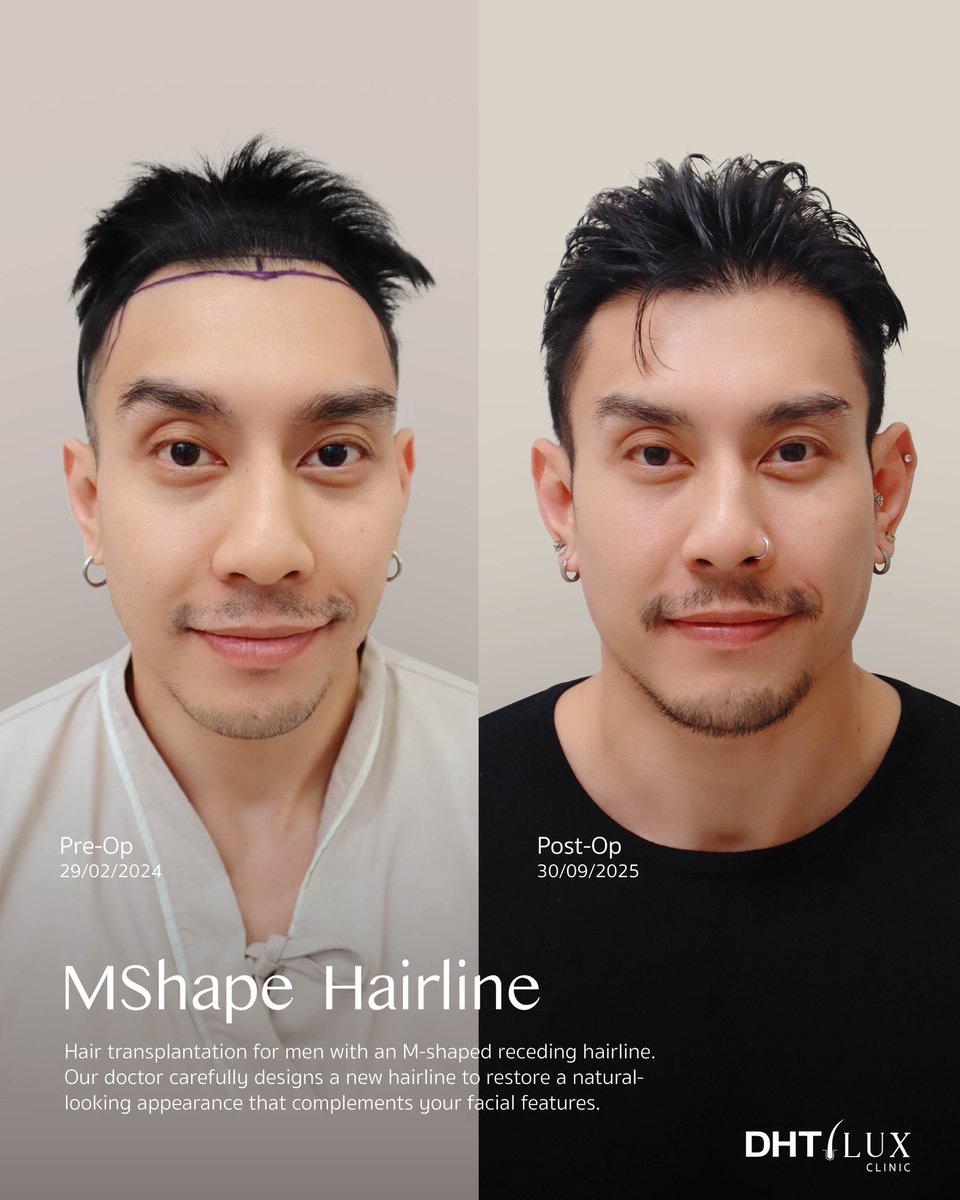 dhtluxclinic's tweet photo. Male FUE Hairline - Hair Transplant 
Update Result 1 Years 7 Months
.
Enhance your facial frame with a natural-looking hairline. Restore a genetically receding hairline with Shaven FUE, featuring a physician-designed hairline for natural-looking results. https://t.co/lWhqsAfkI1