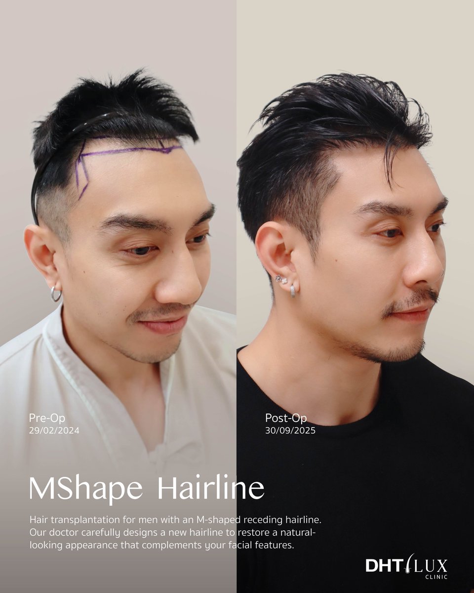 dhtluxclinic's tweet photo. Male FUE Hairline - Hair Transplant 
Update Result 1 Years 7 Months
.
Enhance your facial frame with a natural-looking hairline. Restore a genetically receding hairline with Shaven FUE, featuring a physician-designed hairline for natural-looking results. https://t.co/lWhqsAfkI1