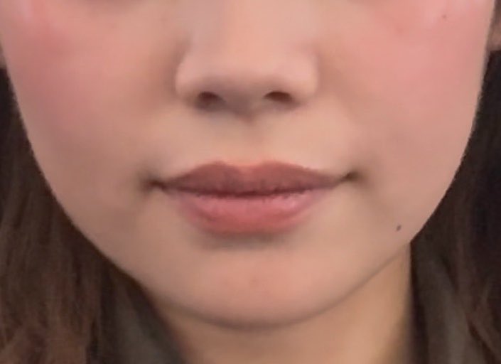 084nyanchuu's tweet photo. 1週間前に初オンダして結構ピタッッ感でてきた🐱🤍🤍
でも口横のポニョはやっぱり消えない結局何が1番効くんだろ🥲🥲🥲 https://t.co/cELnvq0MAx