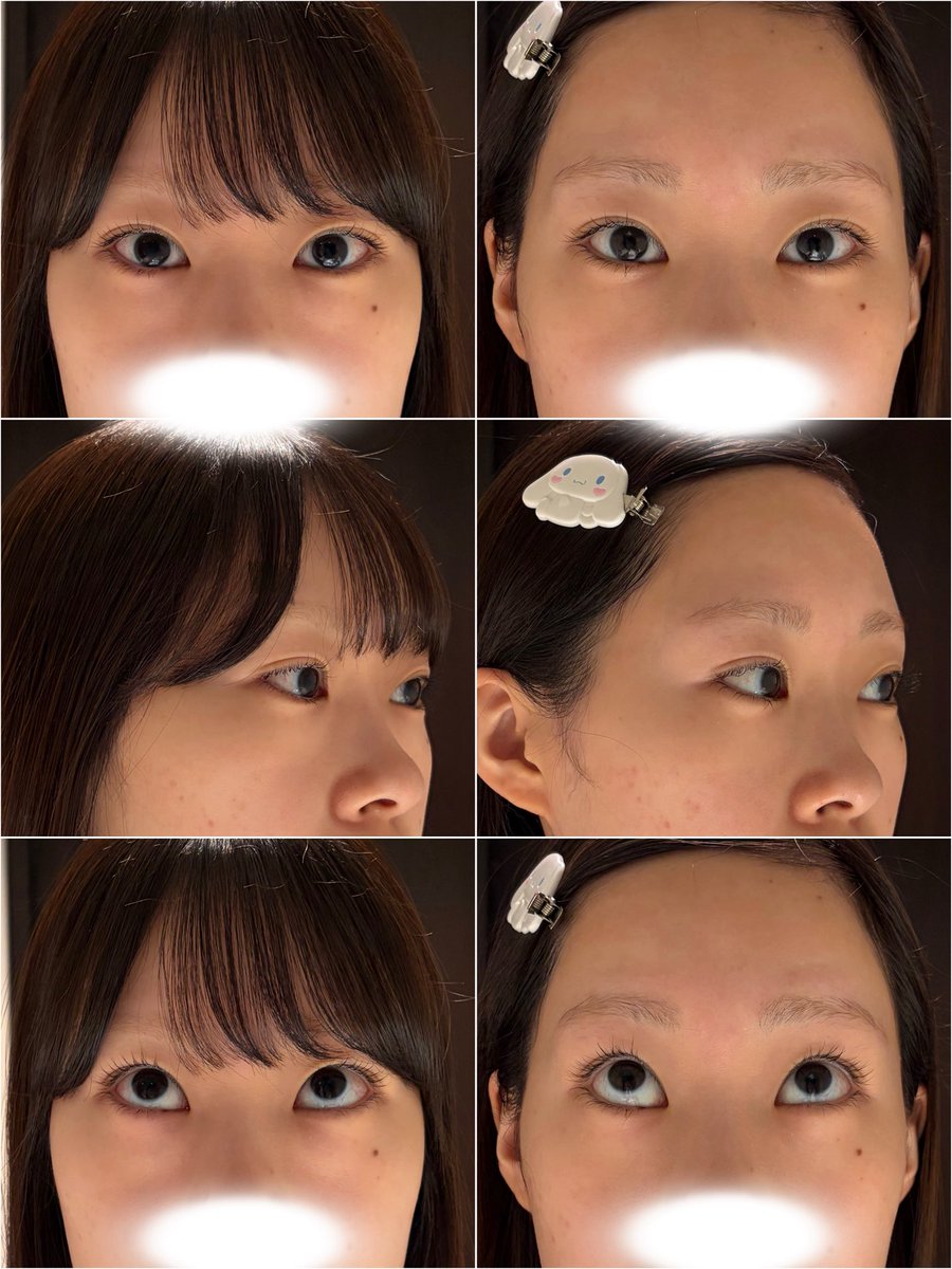 lxori__'s tweet photo. オンユ美容整形外科(@onyoops_jp )さんで目の下の脂肪再配置(+脂肪移植)を受けてから1ヶ月が経ちました🫐🩵

写真でクマ消し加工しなくてよくなったのがほんとに嬉しくて大満足🥹💞
もう前の顔思い出せないくらい安定してきた👍🏻

#オンユ美容整形外科 https://t.co/zY1IQQSfLG