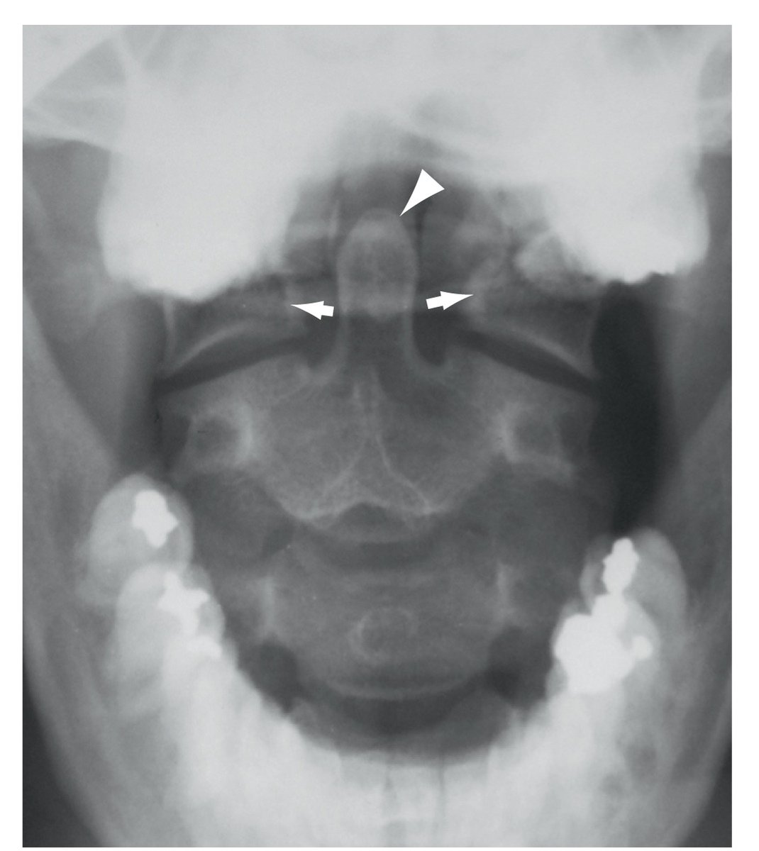 PasionAnatomia's tweet photo. ¿Sabéis que en una radiografía con la boca abierta se puede ver la proyección del #DienteDelAxis (C2) [punta de flecha] y las #MasasLaterales del #Atlas (C1) [flechas]?
📚Netter’s atlas of human anatomy, ed 8. https://t.co/Gqvbltlvzf