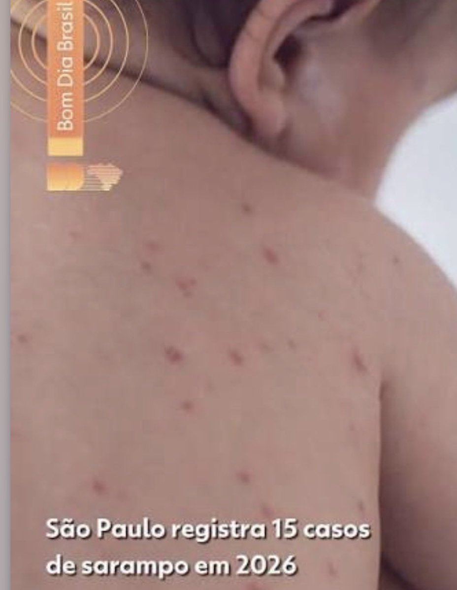 PedroRonchi2's tweet photo. Os casos de sarampo estão aumentando e a extrema direita ao invés de incentivar a vacinação, ataca vacina. https://t.co/TjR8A5wwrj