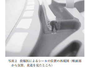AoringoDr's tweet photo. 🚨たった1cmのシールが、全身麻酔での手術につながることがあります。
「シールくらい…」と思っていませんか？

【Injury Alert No. 55】0歳7か月の女の子が、1.0×1.0cmのプラスチック製のシールを誤飲した事例です。 
・咳と共に少量の血が出て受診したところ、シールが気道の入り口（声門の直上）に張り付いており、泣くたびに奥へ落ちそうな危険な状態でした。
・気管内に入ると窒息するリスクが高いため、最終的に「全身麻酔」での異物除去手術が行われました。

💡 なぜシールが怖いのか？ 
① 赤ちゃんの気道は激狭い！
・1歳児の気道の断面(声門部)は「約6mm × 2.5mm」しかありません。たった1cmのシールでも、容易に気道を塞いで窒息に繋がる危険性があります。

 ② レントゲンに写らない！ 
・プラスチック素材はX線に写らないため、診断が難航し発見が遅れることがあります。
・過去には喘息などと間違われて長期間発見されなかったケースも報告されています。 

③ 自力で出せない！ 
・赤ちゃんは咳をする力が弱く、気道に入った異物を自力で咳き出して除去することが十分にできません。

子どもが口に含んだら危険なものは、絶対に手の届かない場所へ。

お子さんを守るため、周囲のパパママにもぜひリポストで教えてあげてください🙇‍♂️