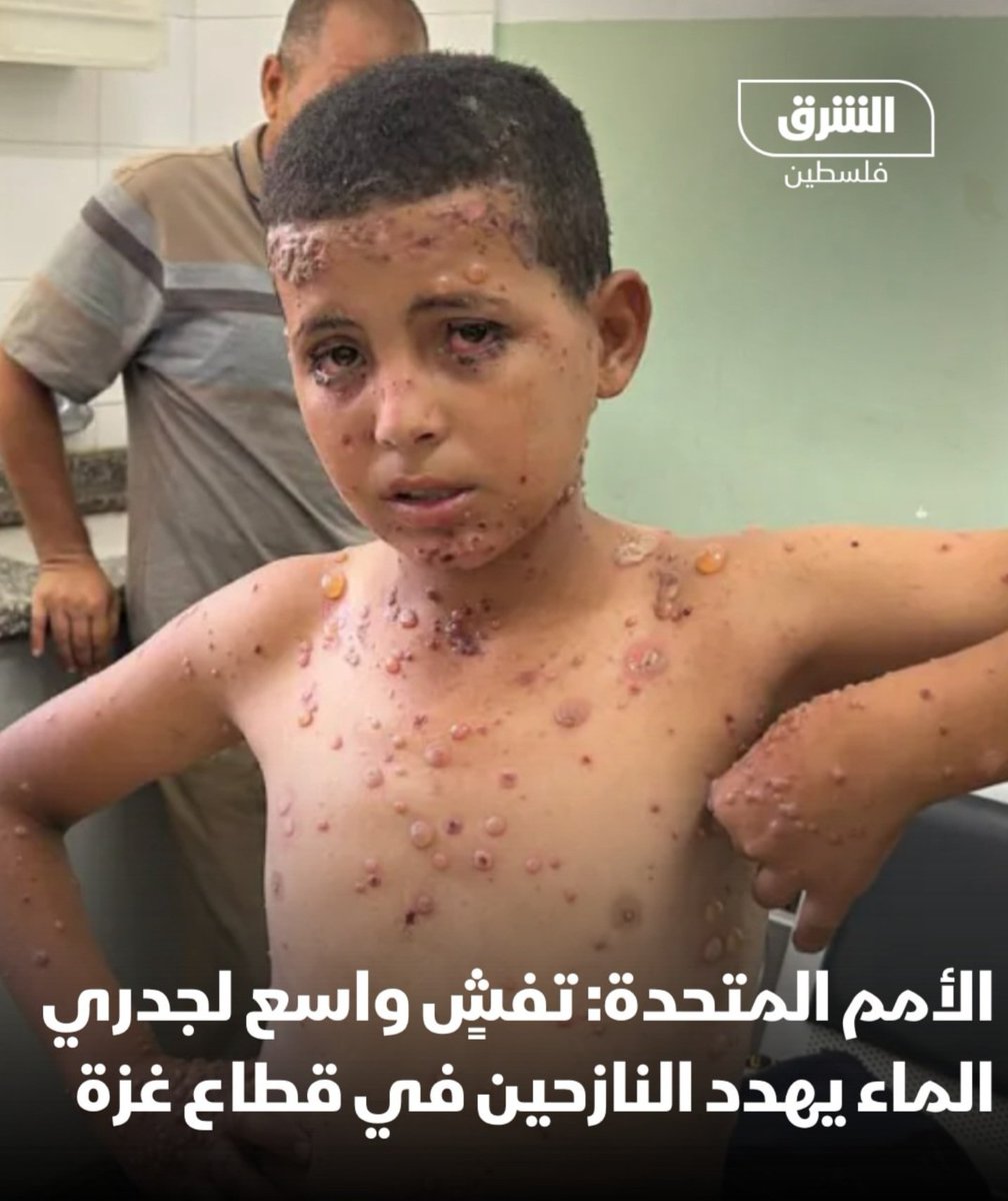 Dr_Muneer1's tweet photo. جدري الماء يتحول إلى وباء في غزة: 58 ألف إصابة وإنذار صحي يستدعي تحركًا عاجلًا

لم يعد الحديث في غزة عن نقص الدواء وحده، ولا عن انهيار المستشفيات فحسب، بل عن وباءٍ يتوسع في بيئة صنعتها الحرب، والنزوح القسري، وتلوث المياه، وانهيار منظومة الصحة العامة.
سجل قطاع غزة أكثر من 58 ألف إصابة بجدري الماء منذ بداية عام 2026، مع تركز أكثر من نصف الإصابات في محافظة خانيونس، وهو ما دفع اللجنة الوطنية للأمراض المعدية إلى اعتبار ما يجري تفشيًا وبائيًا يستوجب تدخلاً عاجلًا ومتعدد القطاعات.
إن هذا الوباء لم ينشأ بمعزل عن الواقع الإنساني الكارثي، بل جاء نتيجة مباشرة للاكتظاظ الهائل في مخيمات النزوح، وتلوث مصادر المياه، وانهيار خدمات الصرف الصحي، وتراكم النفايات، ونقص مستلزمات النظافة. وهي ظروف خلقت بيئة مثالية لانتشار جدري الماء والجرب وغيرها من الأمراض المعدية.
عندما يفقد الإنسان الماء النظيف، ويعيش في خيمة مكتظة، وتتعطل شبكات الصرف الصحي، فإن الأمراض لا تنتشر صدفة، بل تصبح نتيجة حتمية. إن تلوث المياه اليوم لم يعد أزمة خدمات، بل تحول إلى تهديد مباشر للصحة العامة، يطال الأطفال والنساء وكبار السن، ويُنذر بموجات جديدة من الأوبئة.
إن حماية الصحة في غزة لم تعد تقتصر على توفير العلاج، بل تبدأ بحماية مصادر المياه، وتحسين خدمات الإصحاح البيئي، وتأمين بيئة إنسانية تحفظ كرامة الإنسان وحقه في الحياة. فالصحة والمياه وجهان لعملة واحدة، وإذا انهار أحدهما، سرعان ما ينهار الآخر.

Chickenpox Becomes an Outbreak in Gaza: Over 58,000 Cases Raise an Urgent Public Health Alarm

Gaza is no longer facing only shortages of medicines or the collapse of hospitals. It is now confronting an infectious disease outbreak driven by war, forced displacement, contaminated water, and the collapse of public health infrastructure.
More than 58,000 cases of chickenpox have been recorded since the beginning of 2026, with over half of the cases concentrated in Khan Younis. The situation has been classified as an outbreak requiring an urgent multi-sectoral response.
This outbreak is a direct consequence of overcrowded displacement camps, contaminated water supplies, failing sanitation systems, accumulated waste, and severe shortages of hygiene materials. These conditions have created an ideal environment for the spread of chickenpox, scabies, and other communicable diseases.
When people are deprived of safe water, forced to live in overcrowded shelters, and sanitation systems collapse, infectious diseases do not spread by chance—they become inevitable. Water contamination is no longer merely a service failure; it is a major public health threat, particularly for children and other vulnerable populations.
Protecting health in Gaza requires more than medical treatment. It begins with protecting safe water supplies, restoring sanitation services, and ensuring dignified living conditions. Public health and safe water are inseparable; when one collapses, the other inevitably follows.