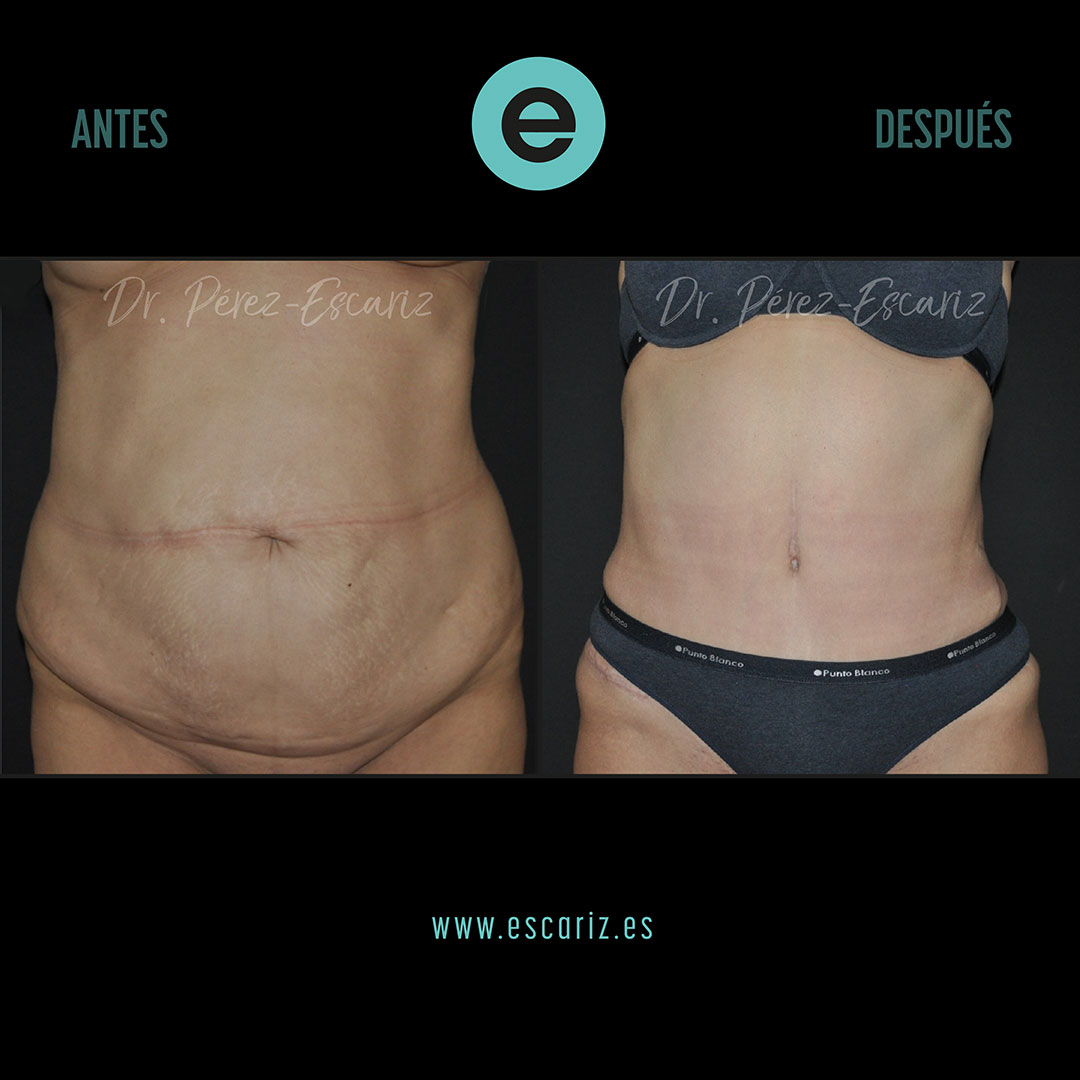 DrPerezEscariz's tweet photo. En este caso, una abdominoplastia con liposucción 360º permitió reconstruir la pared abdominal, reparar dos hernias y remodelar el contorno corporal, mejorando tanto la función como la calidad de vida de la paciente.
#Abdominoplastia #Liposucción https://t.co/Bmm4Aq5TZ3