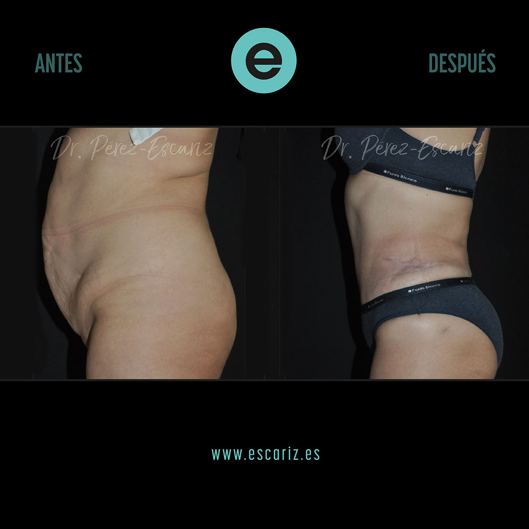 DrPerezEscariz's tweet photo. En este caso, una abdominoplastia con liposucción 360º permitió reconstruir la pared abdominal, reparar dos hernias y remodelar el contorno corporal, mejorando tanto la función como la calidad de vida de la paciente.
#Abdominoplastia #Liposucción https://t.co/Bmm4Aq5TZ3