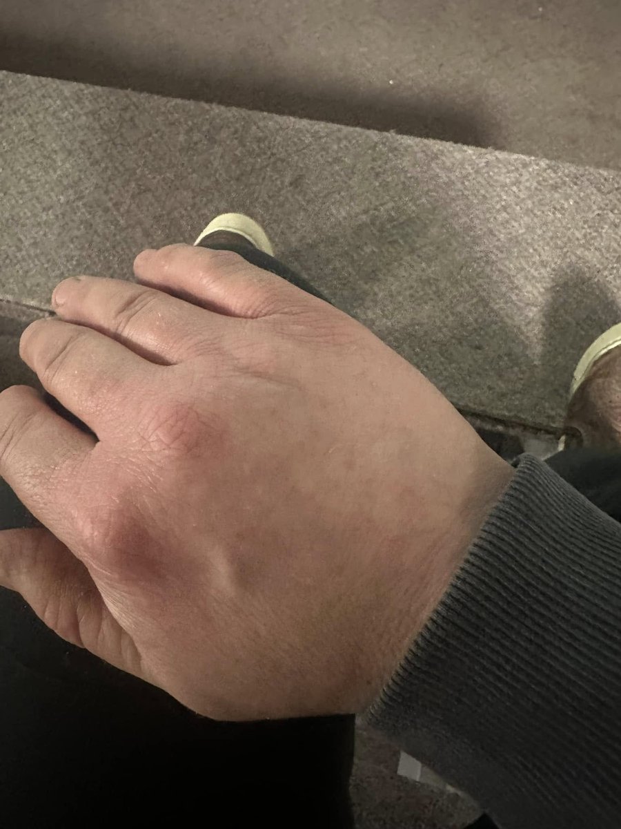 xYsfknBXPT6M0jo's tweet photo. 转发

好的，我要分享一些真实的东西。
牛皮癣真是个混蛋。我已经患病20年了。

20年的瘙痒。20年的隐藏。20年的感觉好像我的皮肤不属于我。

我再也受不了了。
2024年我全身都覆盖满了。从头到脚。太令人沮丧了。那种让你不想出门的那种沮丧。

我试过一切。药膏。注射。处方药。什么都不管用。真的不行。

然后我发现了一个关于伊维菌素和癌症的页面。
我读到了一些让我停下来的东西：牛皮癣可能是寄生虫引起的。

我想，“见鬼去吧——我给我的动物定期驱虫。为什么不给自己试试？”

所以我做了。

3轮伊维菌素

3轮 Safeguard（芬苯达唑）

总共6周

每轮后休息1周

我的朋友们……它真的奏效了。
我不再觉得皮肤下面有东西在爬。

我睡得更好。

每个月的那几天？现在几乎不让我难受了。

我每天都正常大便——以前从来没有过。

我的皮肤痊愈了。
我简直不敢相信自己会这么说。

经过20年的折磨。

我相信我的直觉。
我很高兴我这么做了。

叫我疯子。我不在乎。因为我没疯。

我只是一个尝试了不同方法并找回生活的人。

⚠️ 不是医疗建议——只是我的个人经历。请自己研究。