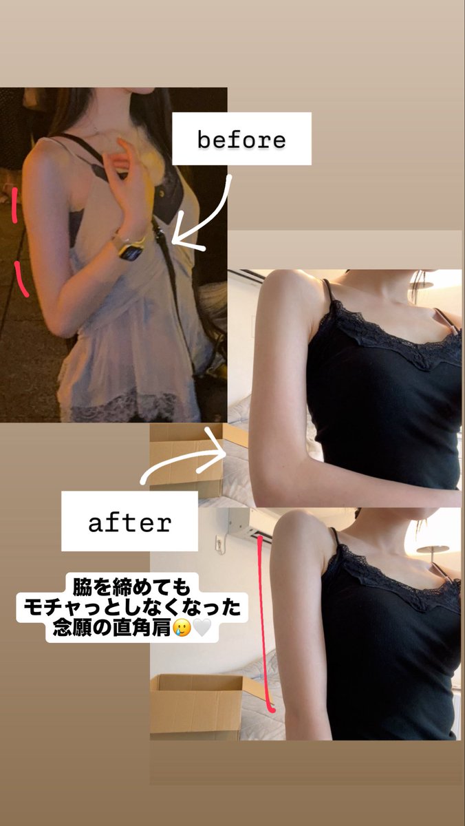 mndk_biyouno's tweet photo. 🏥WOOA美容外科　【@wooajp 】

先日wooa美容外科で二の腕にオンダリフトを当てて貰いました✨【施術提供】

初めてだったのですが、マーキングから丁寧でとても安心して受けられました！だいぶ肩が直角に近づいて嬉しい🥹🤍

豊胸のイメージが強いですが、リフトアップのデバイスも多かったです！ https://t.co/TwsuJgmb0u