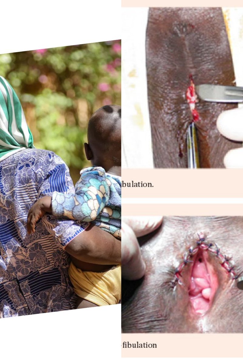 thegirdlengr's tweet photo. My #FGM Torture💔
"I Had A Narrowed Vaginal Orifice Due To FGM And It Almost Cost My Life And Baby's!"

Aichata Recounts:
"I am 20 years old and a mother of two. I was married at 14 but before then, I underwent genital mutilation at the age of seven, in my village in the cercle https://t.co/IwJnA3ODjb