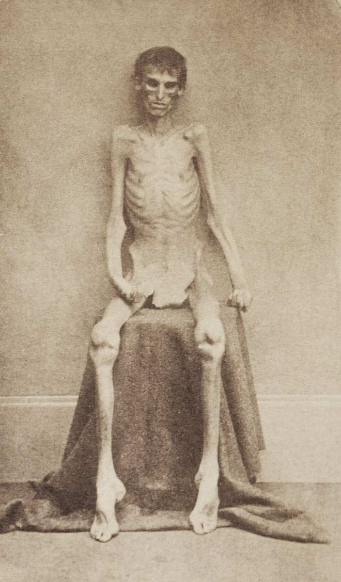 Dr_TheHistories's tweet photo. This harrowing photograph from 1865 shows an unidentified Union soldier who miraculously survived captivity during the American Civil War.... 

The image was captured at a military hospital in Annapolis shortly after his release. While many today mistake this as a photo from the infamous Andersonville prison, historical records show this soldier actually endured the brutal conditions of Belle Isle, a lesser-known but equally deadly camp in Richmond, Virginia.

Why did conditions become so extreme?

Early in the war, both sides routinely traded prisoners through a structured exchange system based on rank. However, in 1863, the system collapsed. The Union began enlisting African American soldiers—and the Confederacy flatly refused to treat black captives as prisoners of war, threatening them with execution or slavery instead. Union General Ulysses S. Grant halted all exchanges unless black soldiers were included. As a result, prison camps on both sides swelled into overcrowded death traps plagued by starvation, scurvy, and dysentery.

The cruelty was not one-sided:
While the North had far superior resources, conditions in Union camps like Elmira Prison ("Hellmira") in New York were catastrophic. Nearly 25% of the Confederate prisoners there died from the freezing climate and lack of fuel—partially due to a deliberate retaliation policy enacted by the Union War Department after photos of emaciated Union survivors began circulating.

Today, the photographs like this one shocked the public and served as crucial evidence in post-war war crimes trials, directly leading to the execution of Andersonville's commandant, Henry Wirz. Yet, out of these medical catastrophes came innovations we still rely on today, including the creation of the first organized battlefield ambulance corps and the modern system of medical triage.

This photograph remains a haunting reminder of the true face of war and the immense human suffering hidden behind the dry numbers of history books.

#drthehistories