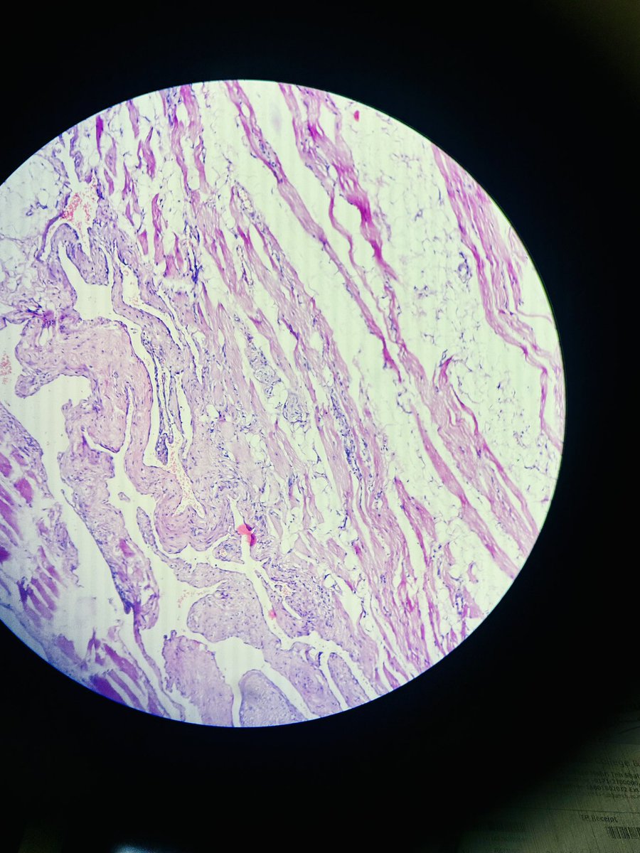 Simrangil128's tweet photo. 11 years female with soft tissue swelling in left hypochondriac region #pathology #softtissue https://t.co/xyGcVt6FdF