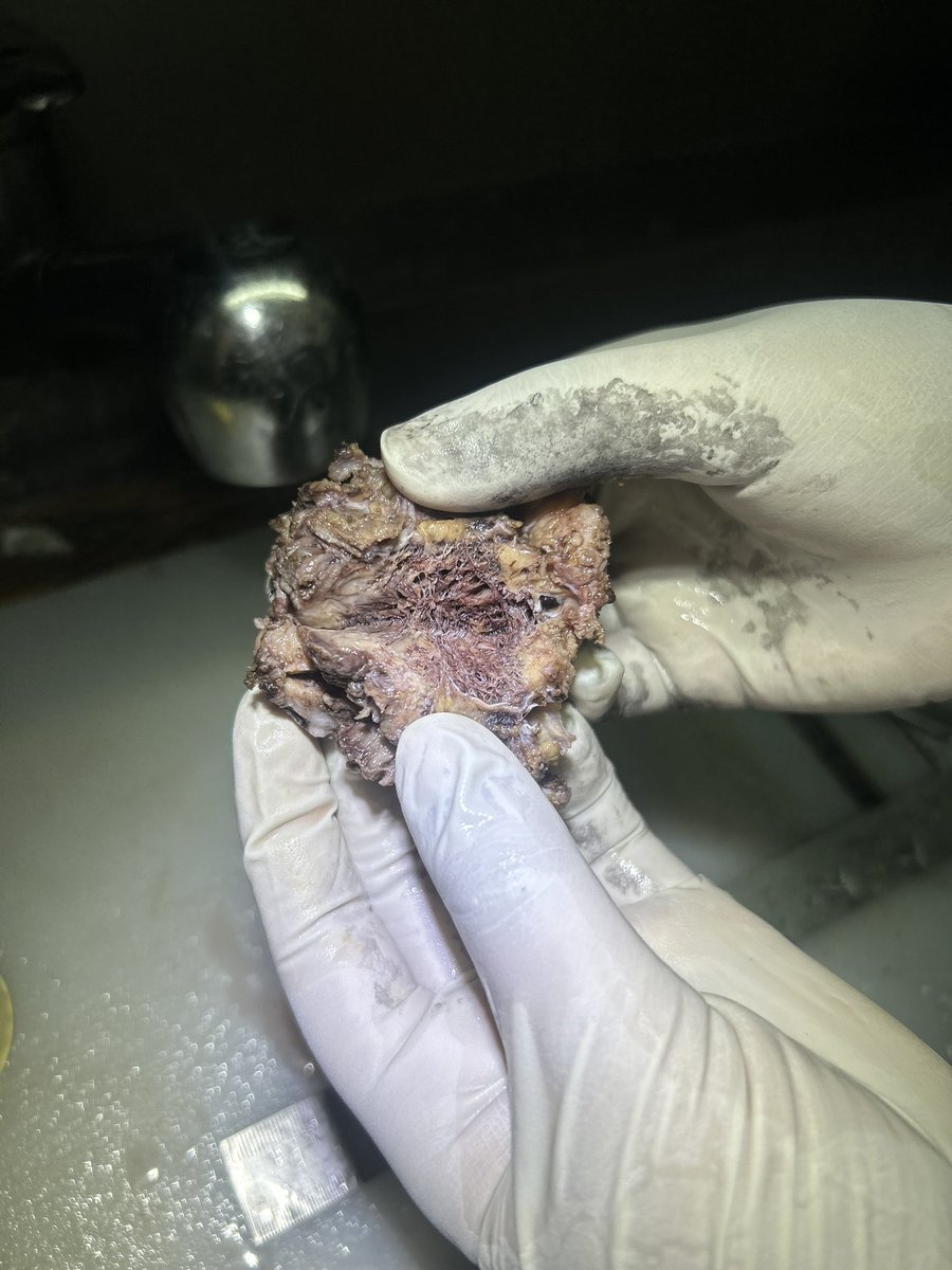 Simrangil128's tweet photo. 11 years female with soft tissue swelling in left hypochondriac region #pathology #softtissue https://t.co/xyGcVt6FdF