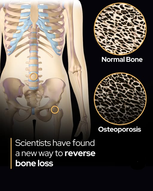 Rainmaker1973's tweet photo. Scientists just found a way to reverse osteoporosis – not just slow it.

Researchers from the University of Leipzig and Shandong University have identified GPR133, a cell-surface receptor that functions as a master regulator of bone-building cells called osteoblasts. When GPR133 is switched on, osteoblasts ramp up activity and dramatically increase bone density.

In mouse experiments, animals engineered without the GPR133 gene developed fragile, porous bones similar to human osteoporosis. However, treating them with a synthetic activator called AP503—a small molecule discovered through computational screening—rapidly strengthened their skeletons. Remarkably, AP503 not only boosted bone mass in healthy mice but also reversed osteoporosis-like damage in older or diseased animals, with even greater effects when paired with physical exercise.

Because GPR133 influences bone density in humans and the underlying molecular pathways are highly conserved across mammals, the findings raise hope for a breakthrough osteoporosis therapy. Unlike existing drugs that merely slow bone loss (and often carry side effects or waning efficacy), a GPR133-activating compound could actively rebuild bone from within.

This approach could be particularly transformative for postmenopausal women, who face the highest risk of debilitating fractures, offering a safer, more effective way to restore skeletal strength.

["The mechanosensitive adhesion G protein-coupled receptor 133 (GPR133/ADGRD1) enhances bone formation." Signal Transduction and Targeted Therapy, 30 June 2025]