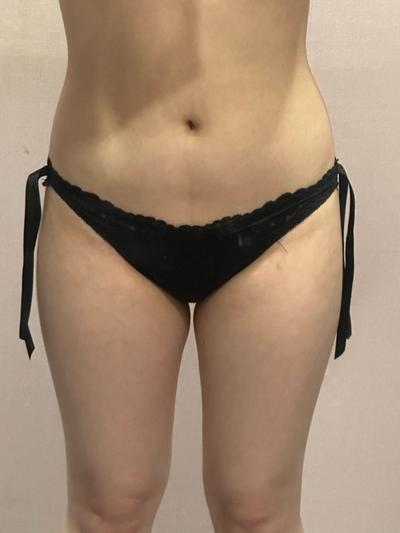 ReadyPs21885's tweet photo. 大腿抽脂＋臀部／骨盆脂肪移植4個月
原本偏直的骨盆與扁平臀型，
現在腰臀轉折更明顯、後側曲線也更立體。
疤痕仍在淡化中，最終效果還需持續觀察脂肪穩定度~
#Ready整形醫院 #手臂抽脂 #超能電漿 #自體脂肪隆乳 #抽脂 #韓國醫美 #醫美優惠 #韓國整形 https://t.co/rTtdqvaUZP
