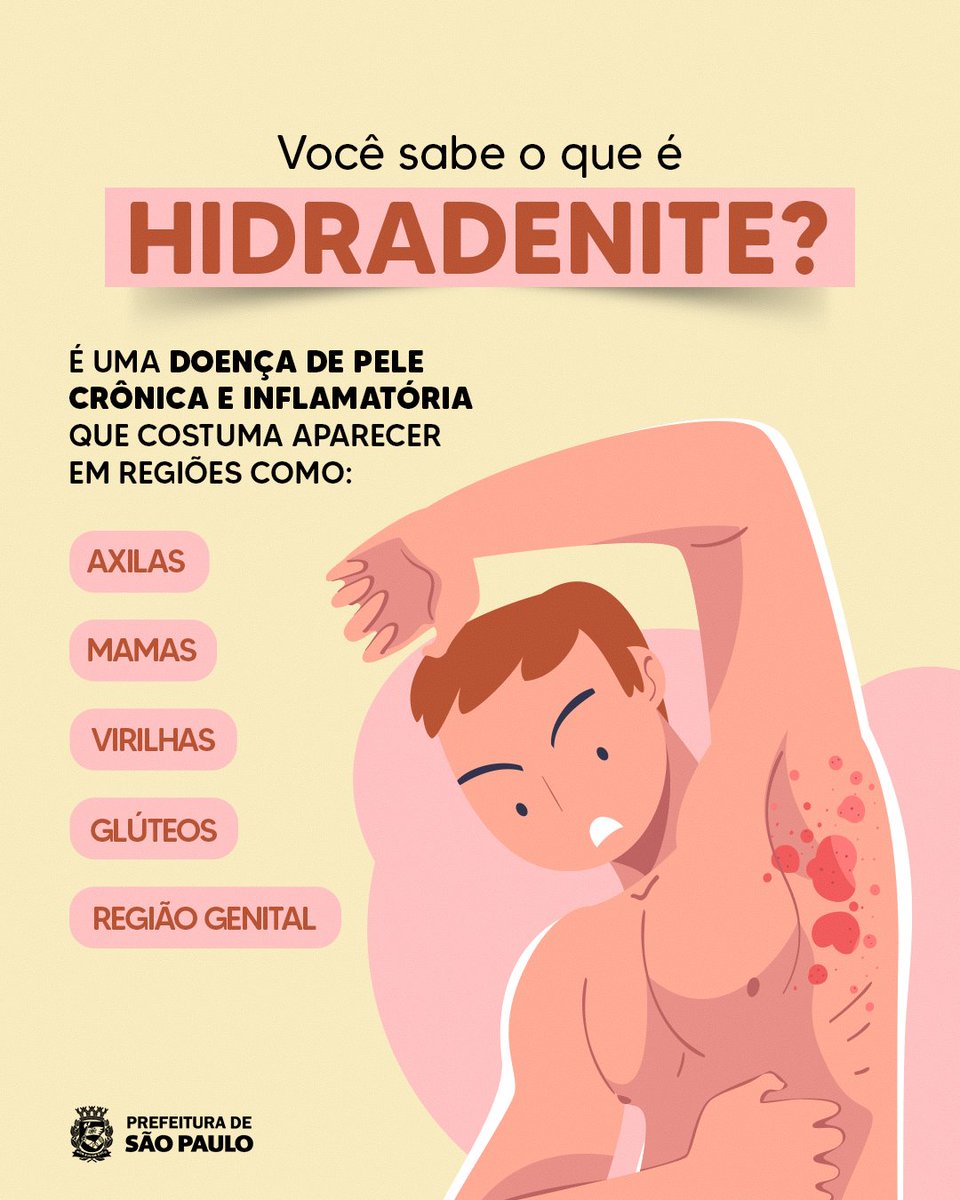 saudeprefsp's tweet photo. Caroços dolorosos e inflamações frequentes em regiões como axilas e virilhas merecem atenção. 👀

Esses sinais podem indicar hidradenite, uma doença de pele crônica que tem tratamento e acompanhamento.

Percebeu algum sintoma? Procure a UBS mais próxima para receber orientação e, quando necessário, encaminhamento para dermatologia. 💙

#SaudePrefSP #Hidradenite #SaudeDaPele #Dermatologia #UBS #PrefeituraDeSaoPaulo