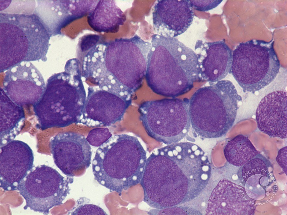 smbenlazar's tweet photo. Pure erythroid leukemia | ASH Image Bank | American Society of Hematology https://t.co/l5gpx1cDqN #ASHImageBank https://t.co/zRr8YrObQZ