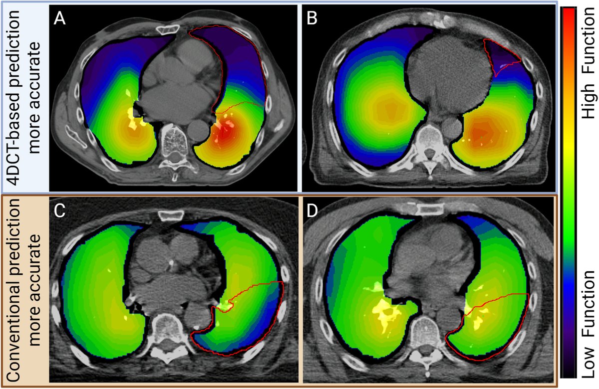 ASTRO_org's tweet photo. New in the #RedJournal: New LIME trial results with @DrLydiaJWilson et al. 4DCT‑ventilation–based predictions of postop lung function showed strong concordance with measured PFTs (CCC 88–91%), meeting the primary endpoint. @KimmelCancerCtr https://t.co/xMBwDHe2Cq https://t.co/e9qw2DsUXs