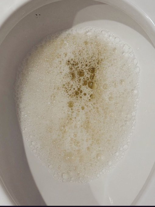 CoachWillStone's tweet photo. Signs you have insulin resistance (&amp; don’t realize it):

1. Foam when you piss. https://t.co/g90r53gmc1
