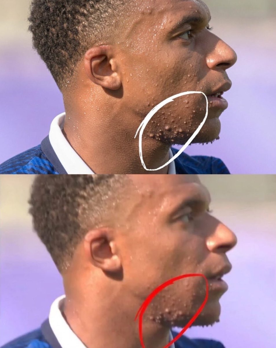 AyaSansFiltre's tweet photo. C’est dû à quoi ce truc sous le menton de Kylian Mbappé ? Le gars a des millions sur son compte, il peut régler ça en 2 minutes en clinique. https://t.co/TH1z6hfnBs