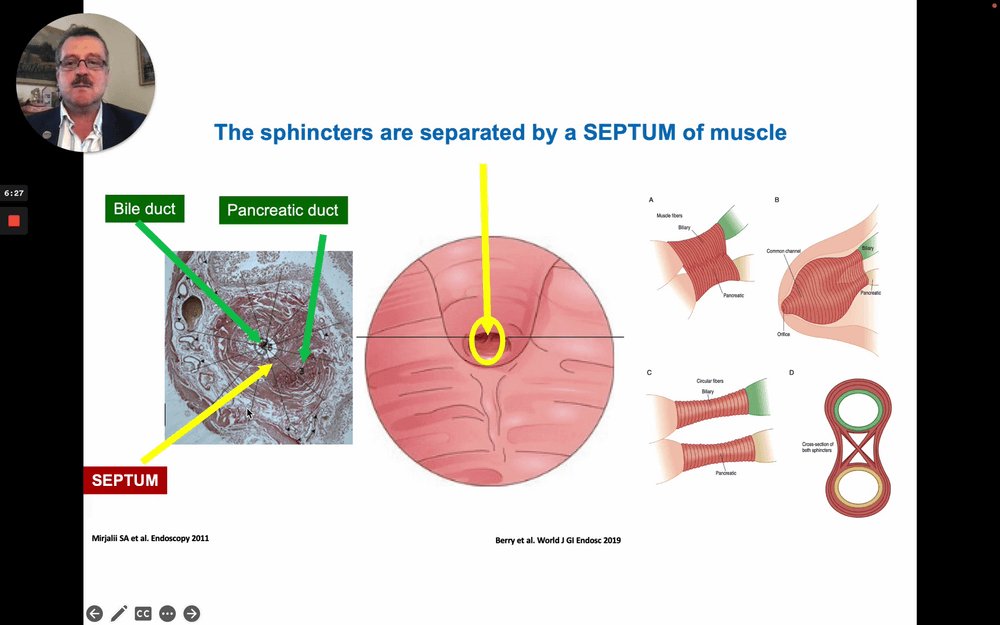 EndoCollabcom's tweet photo. Selective biliary cannulation requires aligning the sphincterotome wire with the natural axis of the bile duct.
 
1/ Understand septum anatomy: the septum separates biliary and pancreatic lumens, dictating the angle of wire entry.
 
2/ Key cannulation principles: maintain en-face papillary position, gentle wire probing, and minimal thermal contact.
 
3/ The compact disc method uses small rotational adjustments of the duodenoscope wheel to match the 11 o'clock duct axis.
 
4/ When cannulation stalls, shift early to advanced tips: wire-guided access, double wire technique, or pre-cut papillotomy.