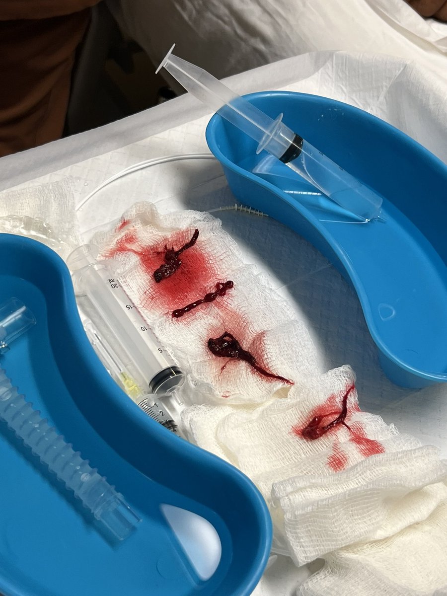 OrlandoRPN's tweet photo. Px con FiO2 al 98% (P/F <100) y en Prono, acidosis respiratoria severa, no hay ECMO.

Está contraindicada la broncoscopia?

No, si eso va a resolver la causa o su mayor contribuyente, en este caso SDRA por aspiración de sangre de tubo digestivo. https://t.co/o0frtjUuip