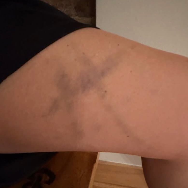 AcervoCharts's tweet photo. Vera Farmiga revelou que apareceram hematomas em forma de cruz em seu corpo durante gravações de “Invocação do Mal". https://t.co/UmfxEwOW05