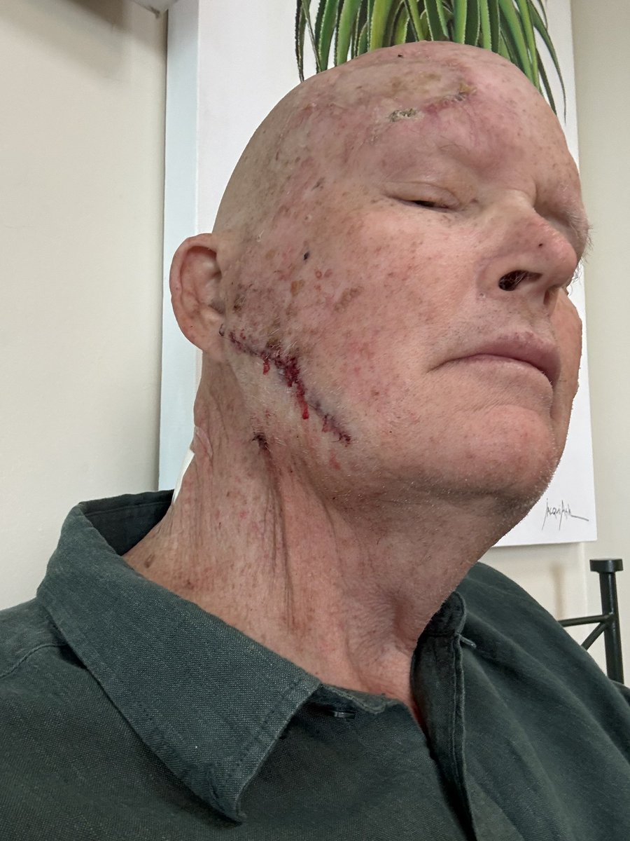 OscarChalupsky's tweet photo. Just one hour after surgery and around 100 internal and external stitches, Dr Greg Ash and I were still smiling. 😂

Cancer can attack my body, but it will never take my spirit.

No Retreat. No Surrender. ❤️

#NoRetreatNoSurrender #CancerWarrior #MultipleMyeloma #ChooseHope https://t.co/jaG24iYSGj