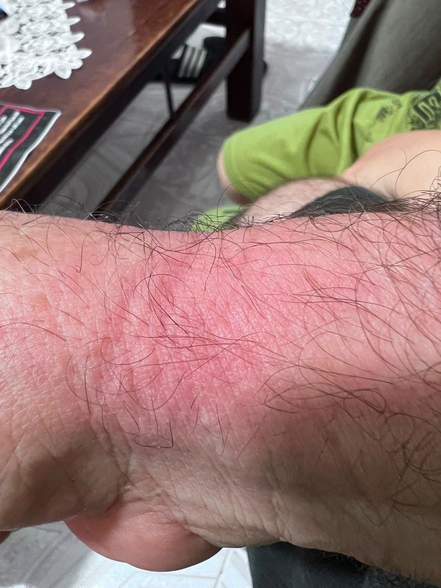 QudsNen's tweet photo. Marks left by plastic restraints on the hand of one of the Palestinian  released by Israeli occupation forces after being detained during the ongoing attacks on Qalandia refugee camp and the town of Kafr Aqab, north of occupied Jerusalem. https://t.co/gOtTz1Mqs3
