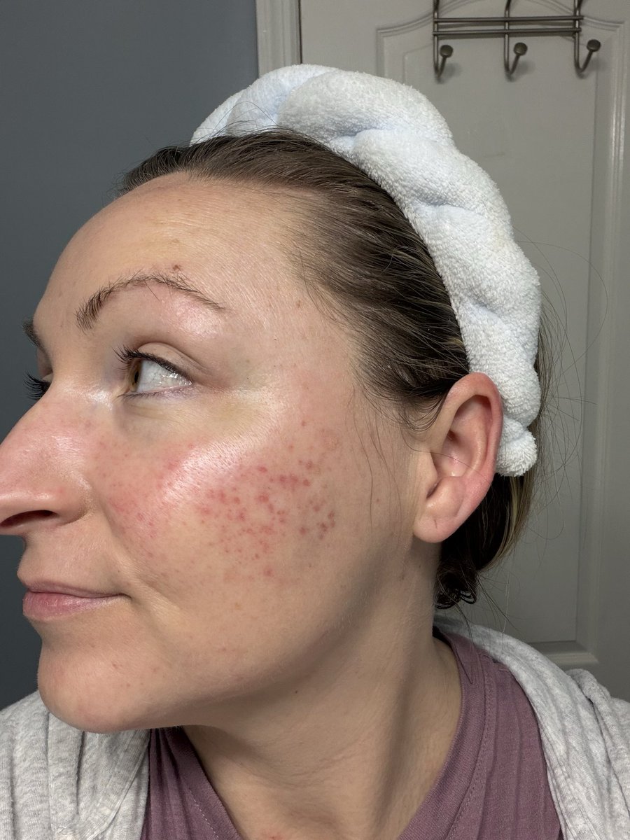 SkinAtPeaceHQ's tweet photo. Rosacea-prone skin deserves skincare that works with your skin, not against it.

This before &amp; after reflects what can happen when your routine is focused on supporting the skin with fresh, preservative-free formulas.

Healthy skin starts with consistency.

#skinatpeace #rosacea https://t.co/7f7Vz8kz3Z