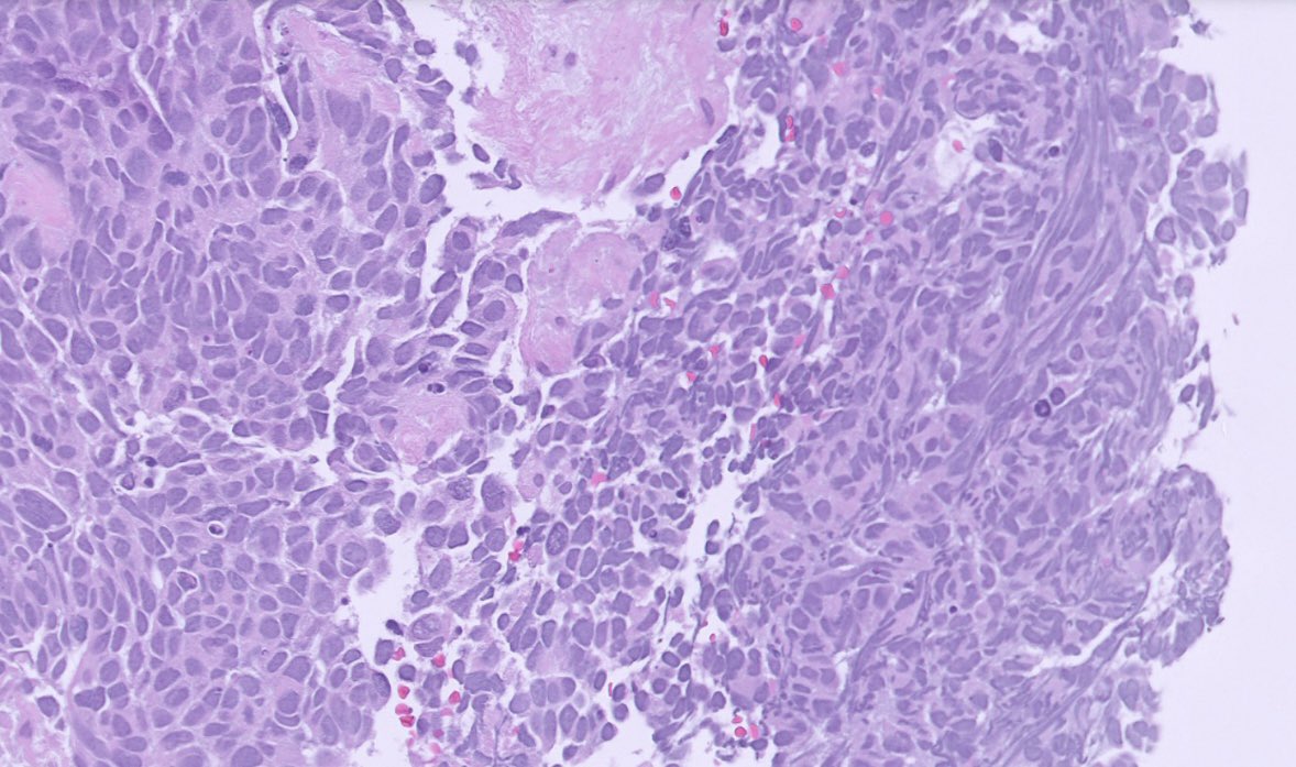 PeterKobalka's tweet photo. Older female SMOKER multiple liver mets.  Initial panel: +AE1/3,  -Syn CG INSM-1 CD56, GATA-3, NUT.  INI-1 and BRG retained.  Based on histology alone dx? (Not a trick; believe your ‘lying’ eyes 😉)  #Thoracicpath #Lungpath #Pulmonarypath #pathtwitter #pathx https://t.co/U9XlKM5GHM