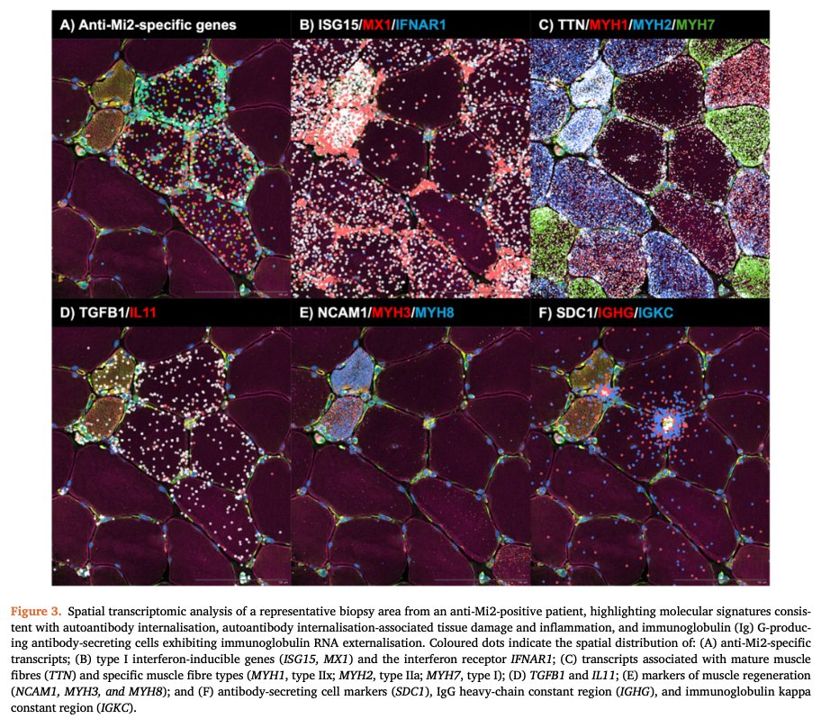 DrIagoPinal's tweet photo. Excited to share our latest @ARD_BMJ study! We reveal the mechanism by which autoantibodies enter cells, disrupt their target autoantigens, and drive tissue injury and inflammation in myositis and other autoimmune diseases. 🧬

https://t.co/nbX62hRSb6 https://t.co/PFV9VbGDDM