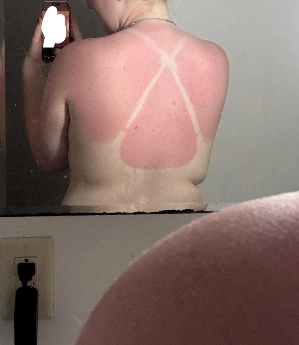 MedicalNews07's tweet photo. Why do white skinned people get sunburned more easily? https://t.co/jXIWSlxXeF