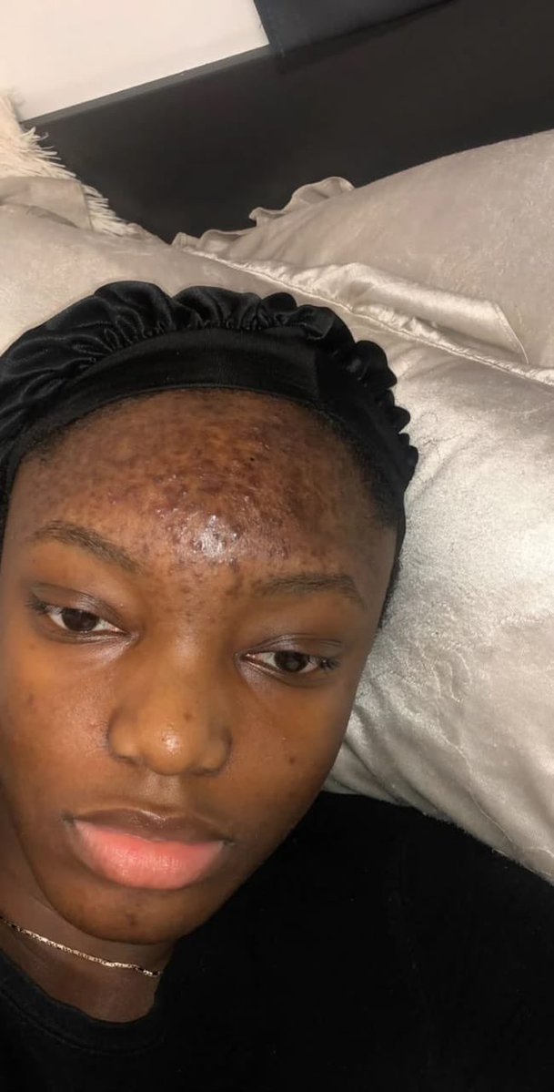 UTDAhmard's tweet photo. My girlfriend has been experiencing facial rashes since she switched to a new face cream. What could be the possible cause? https://t.co/wyTBNGPEu9